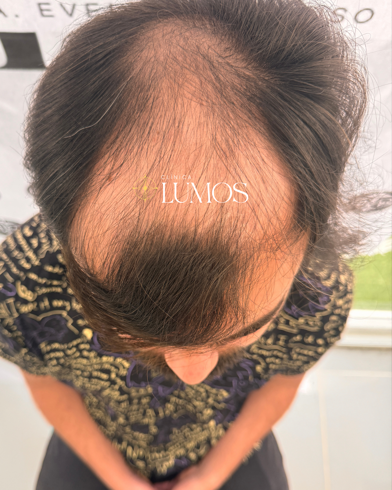 antes y después de trasplante capilar con resultado natural en línea frontal en Viña del Mar