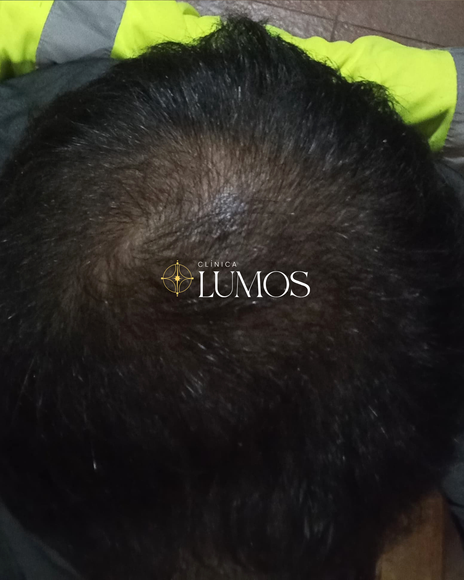 clinica-capilar-en-santiago