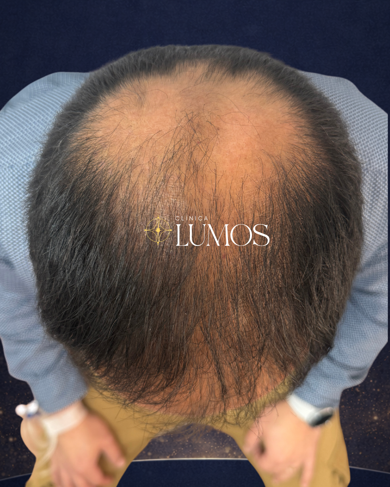 clinica-capilar-en-santiago