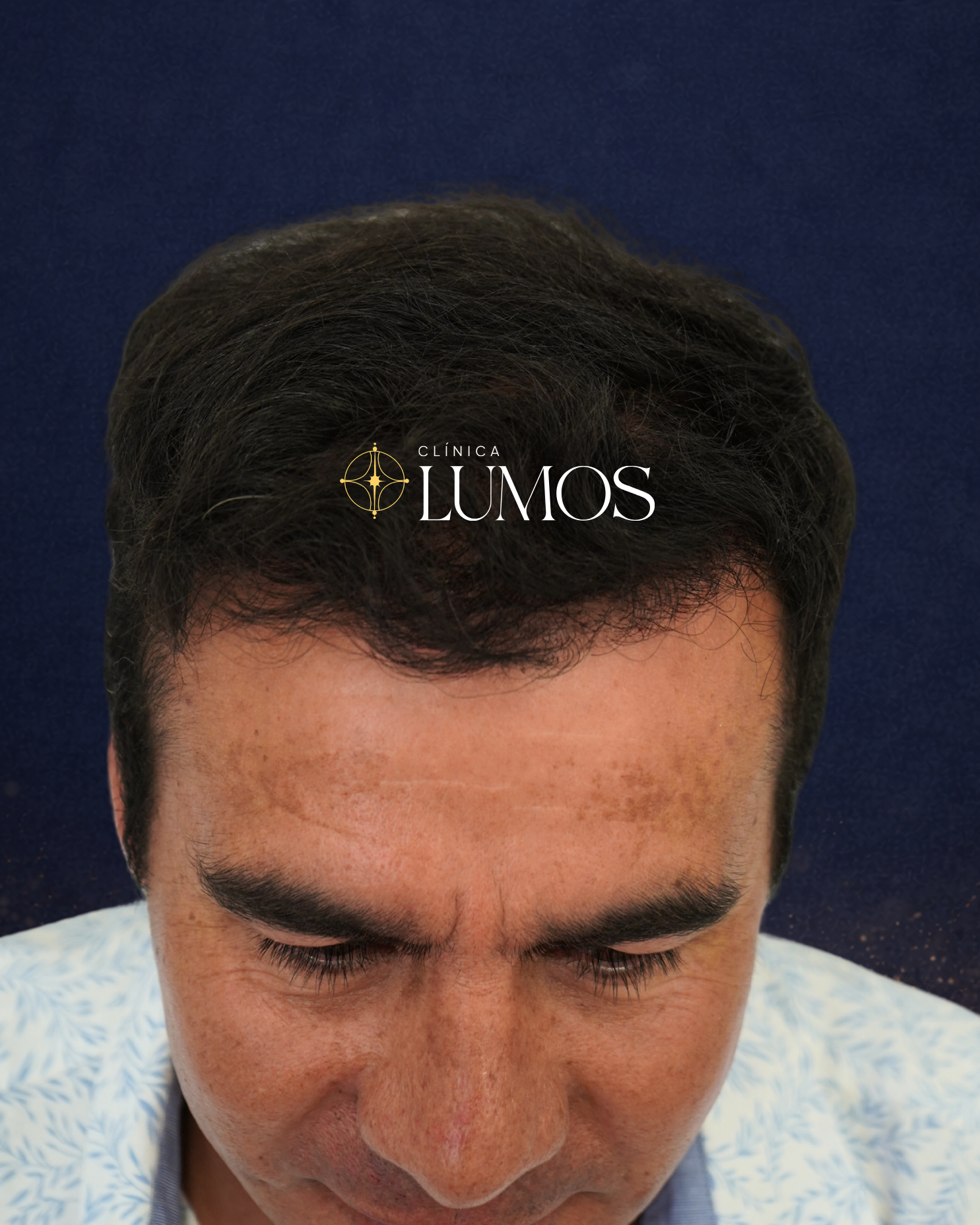 clinica-capilar-en-santiago