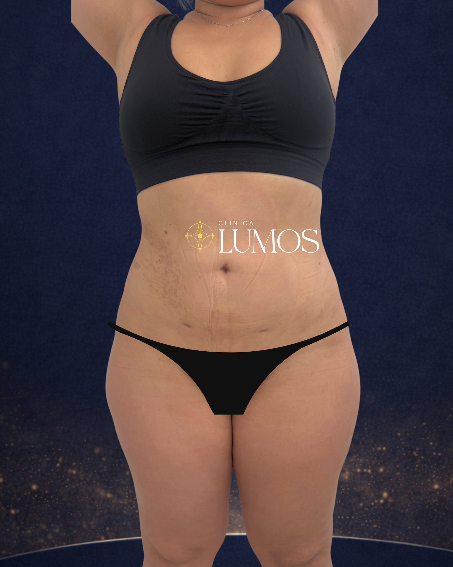 lipolaser cambios de una lipovaser