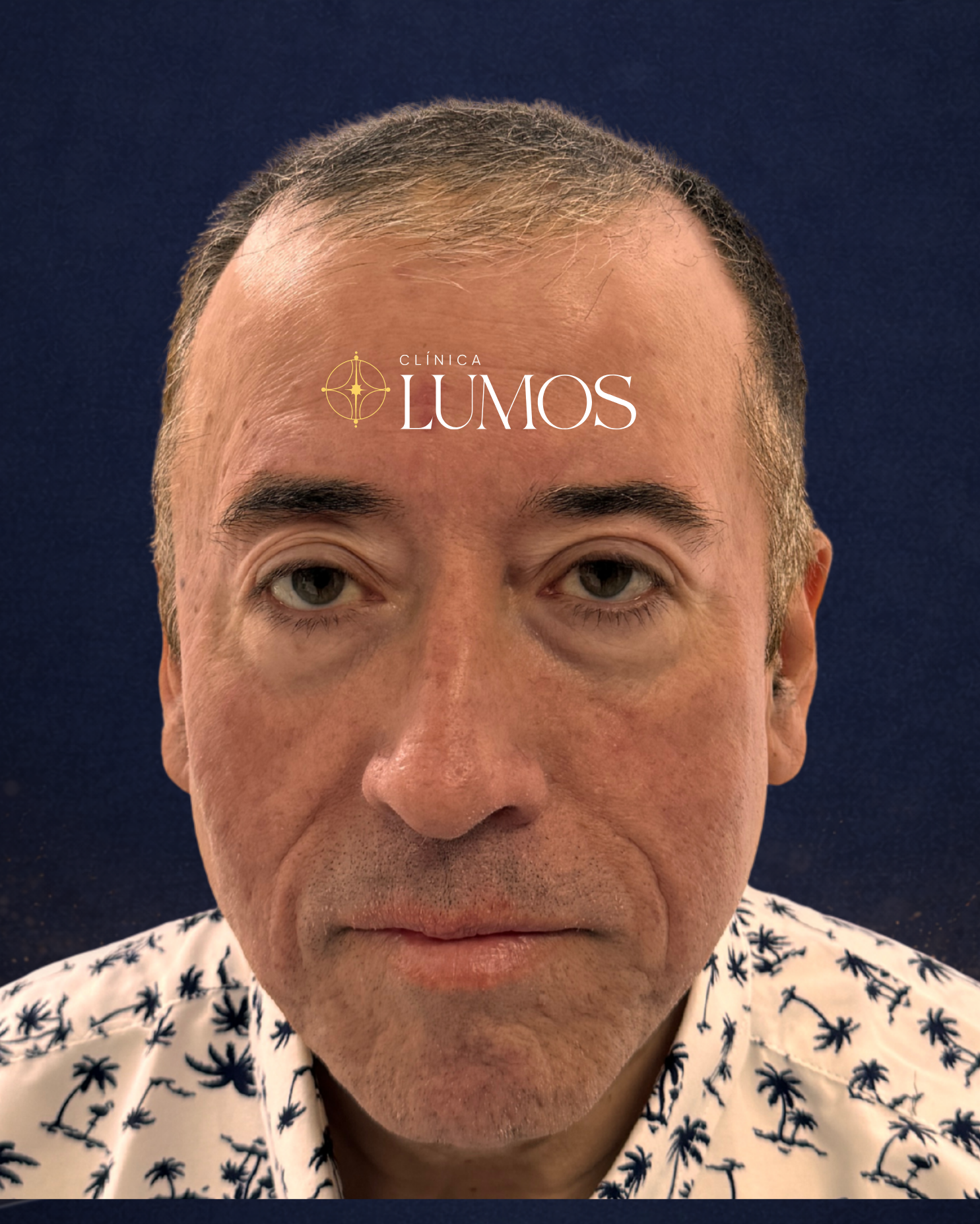 restauración capilar en línea frontal, zona parietal y coronilla con resultado armónico en Viña del Mar