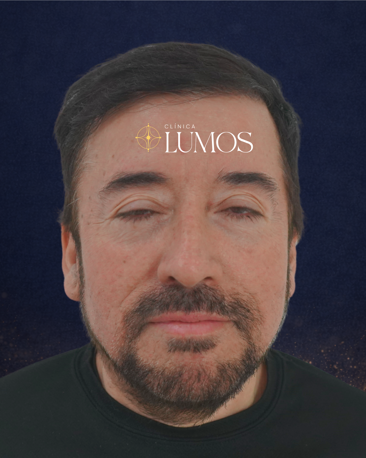 restauración capilar en línea frontal, zona parietal y coronilla con resultado armónico en Viña del Mar