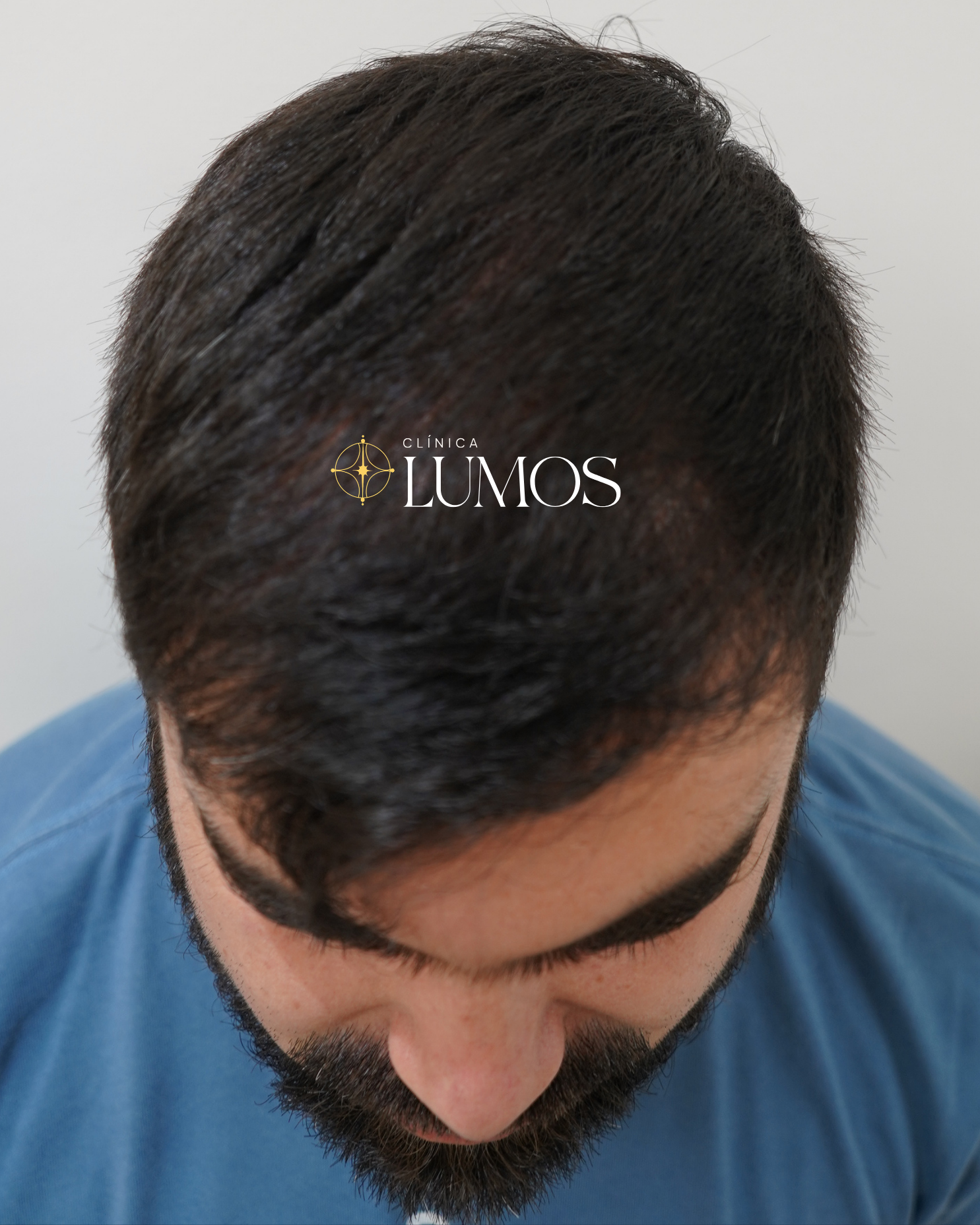 trasplante capilar de alta densidad, linea frontal, cornilla, zona parietal con resultado natural en Viña del Mar