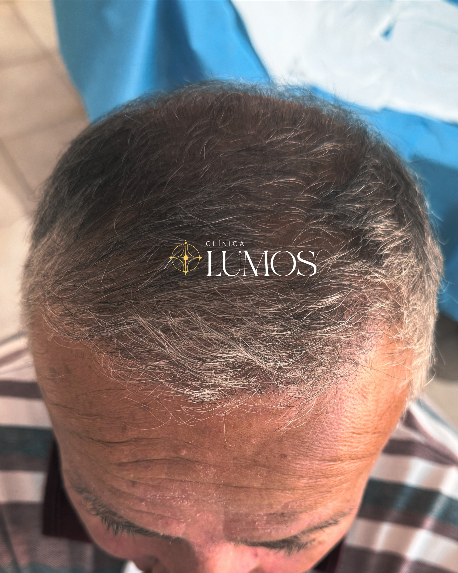 implante-capilar