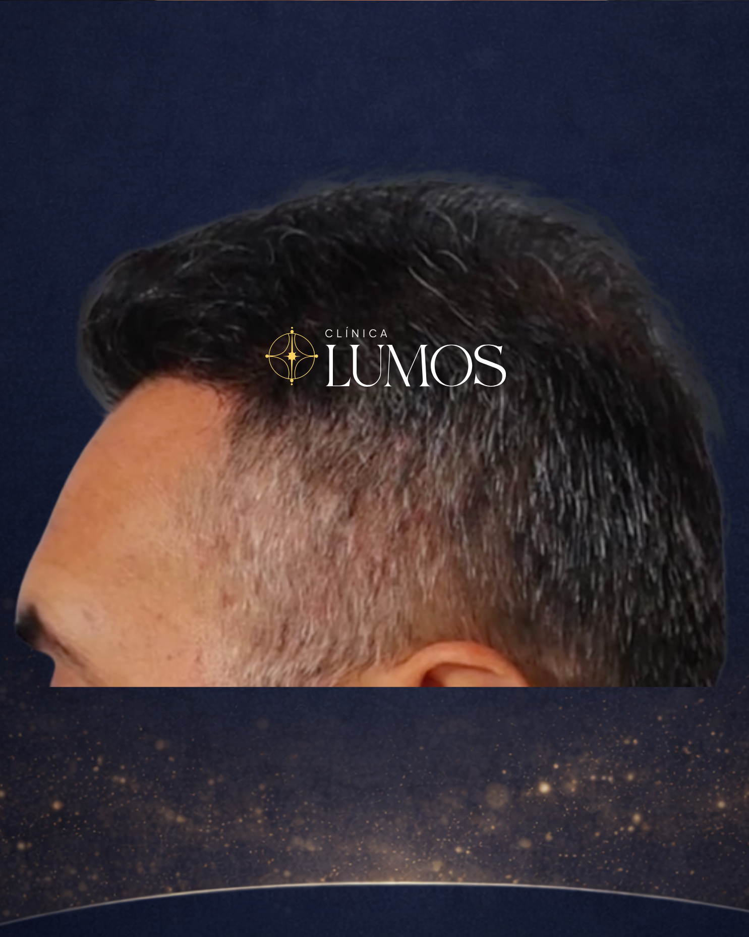 alta densidad implante capilar