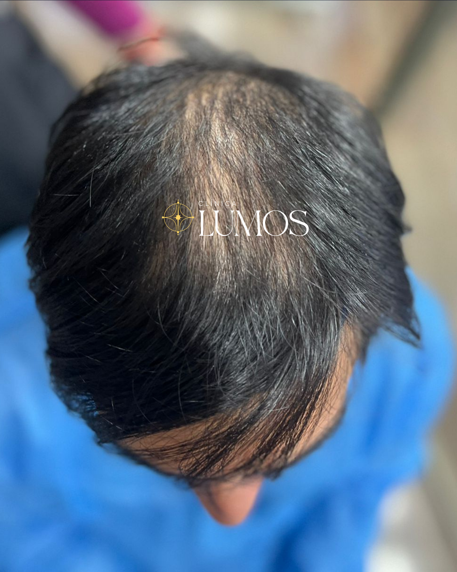 cirugia capilar