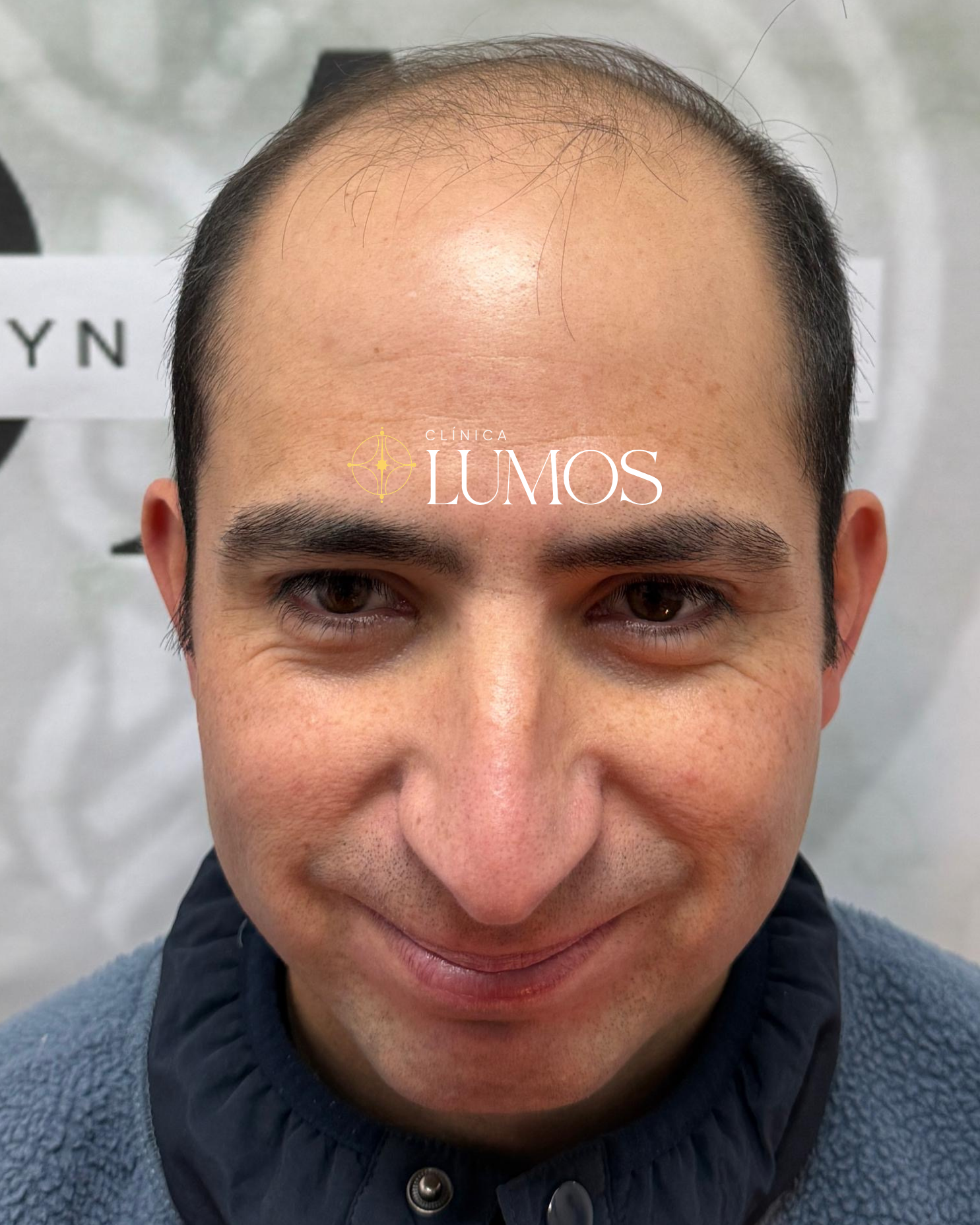 eliminar-la-calvicie