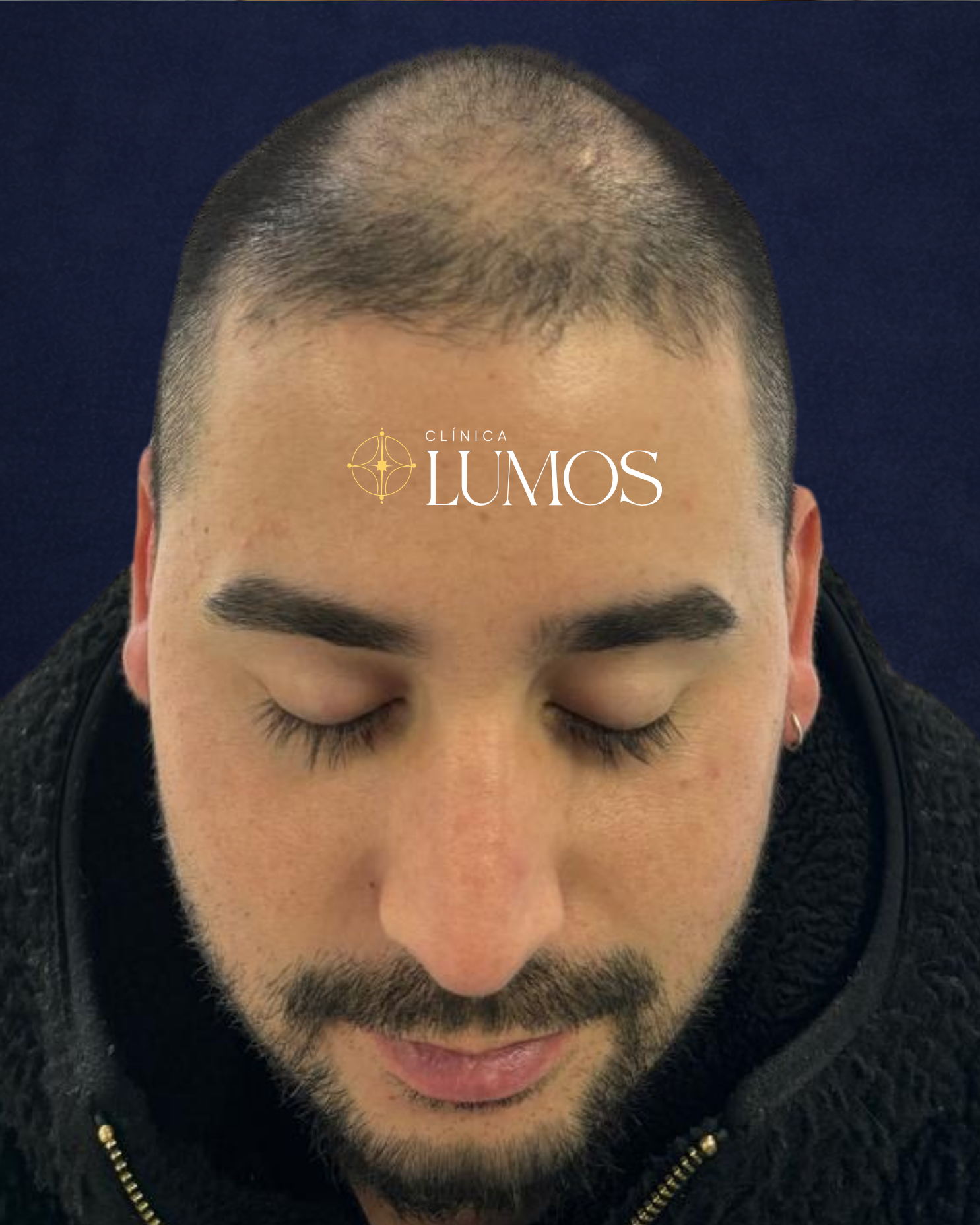 trasplante capilar con alta densidad en línea frontal y zona parietal en Viña del Mar