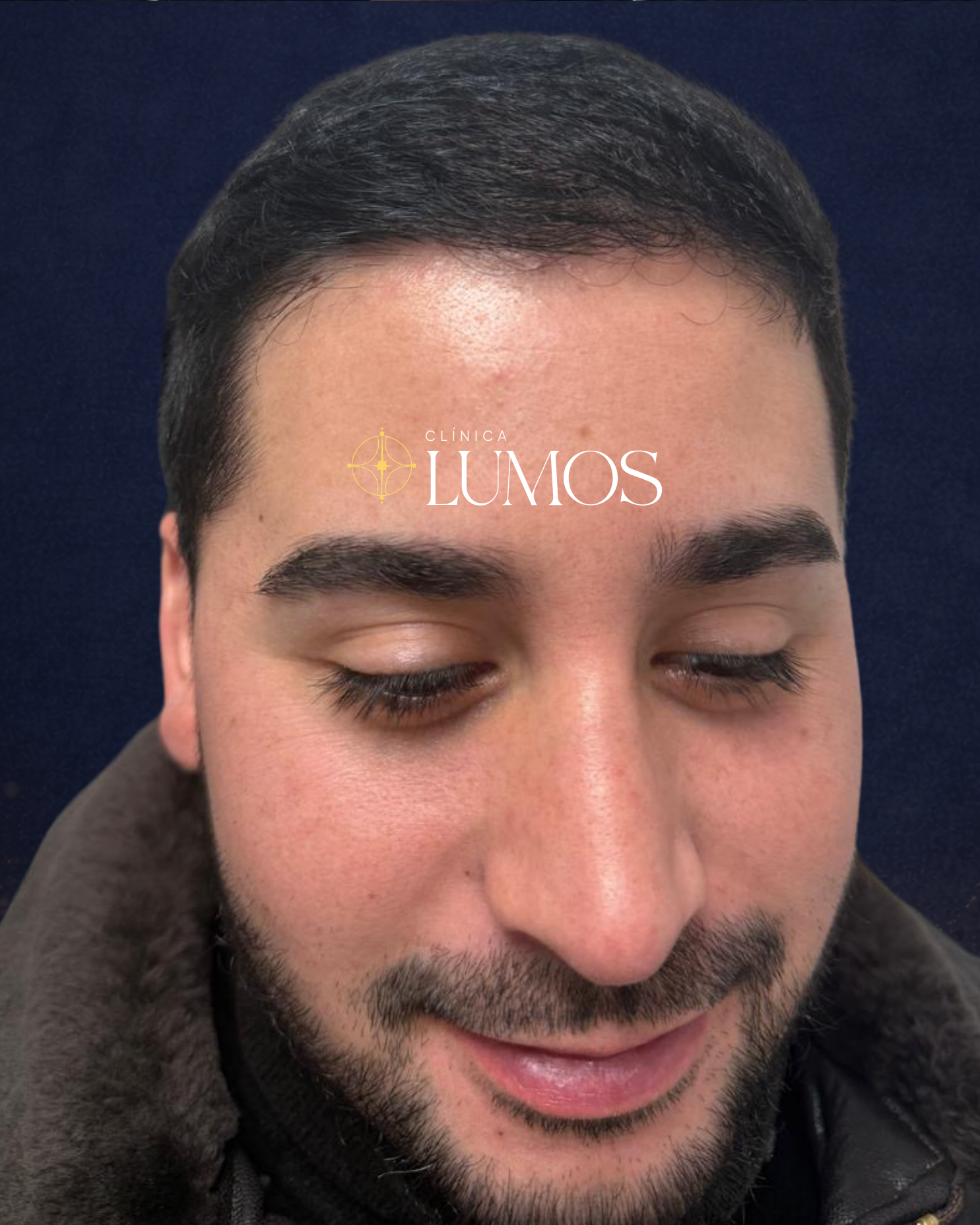 trasplante capilar con alta densidad en línea frontal y zona parietal en Viña del Mar