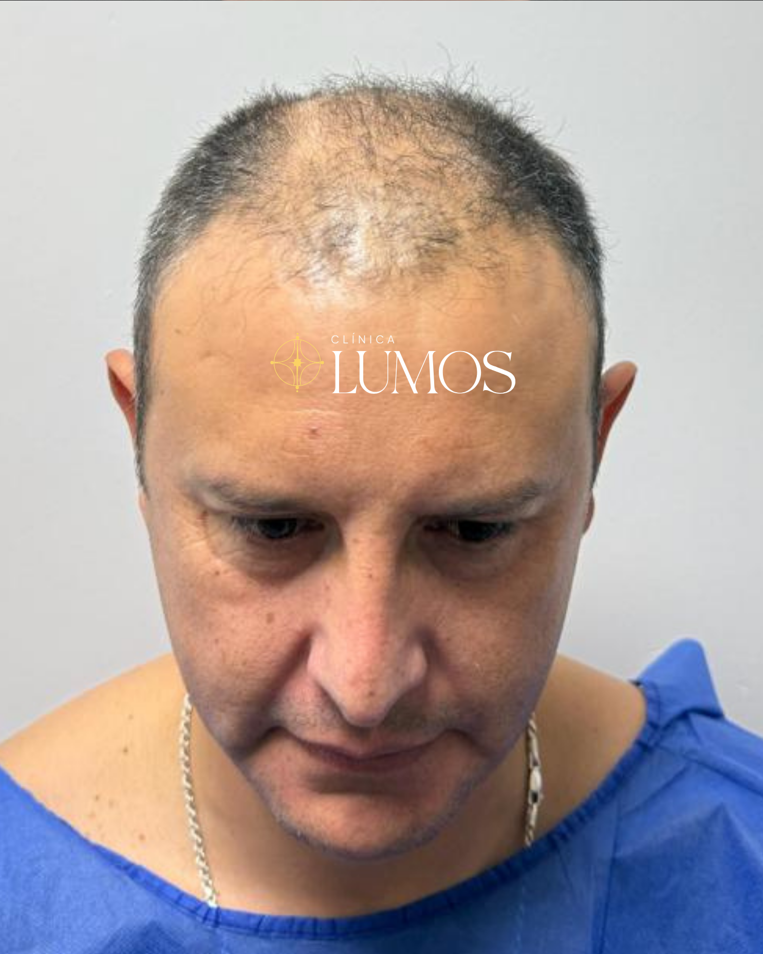 trasplante capilar en zona parietal y línea frontal con resultado natural en Viña del Mar