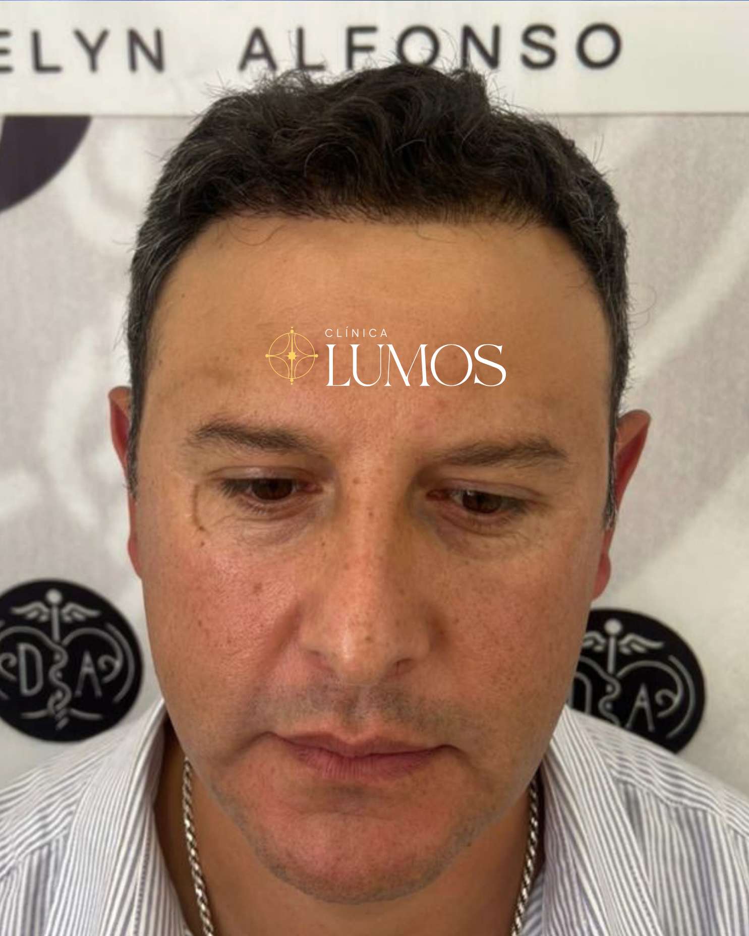 trasplante capilar en zona parietal y línea frontal con resultado natural en Viña del Mar