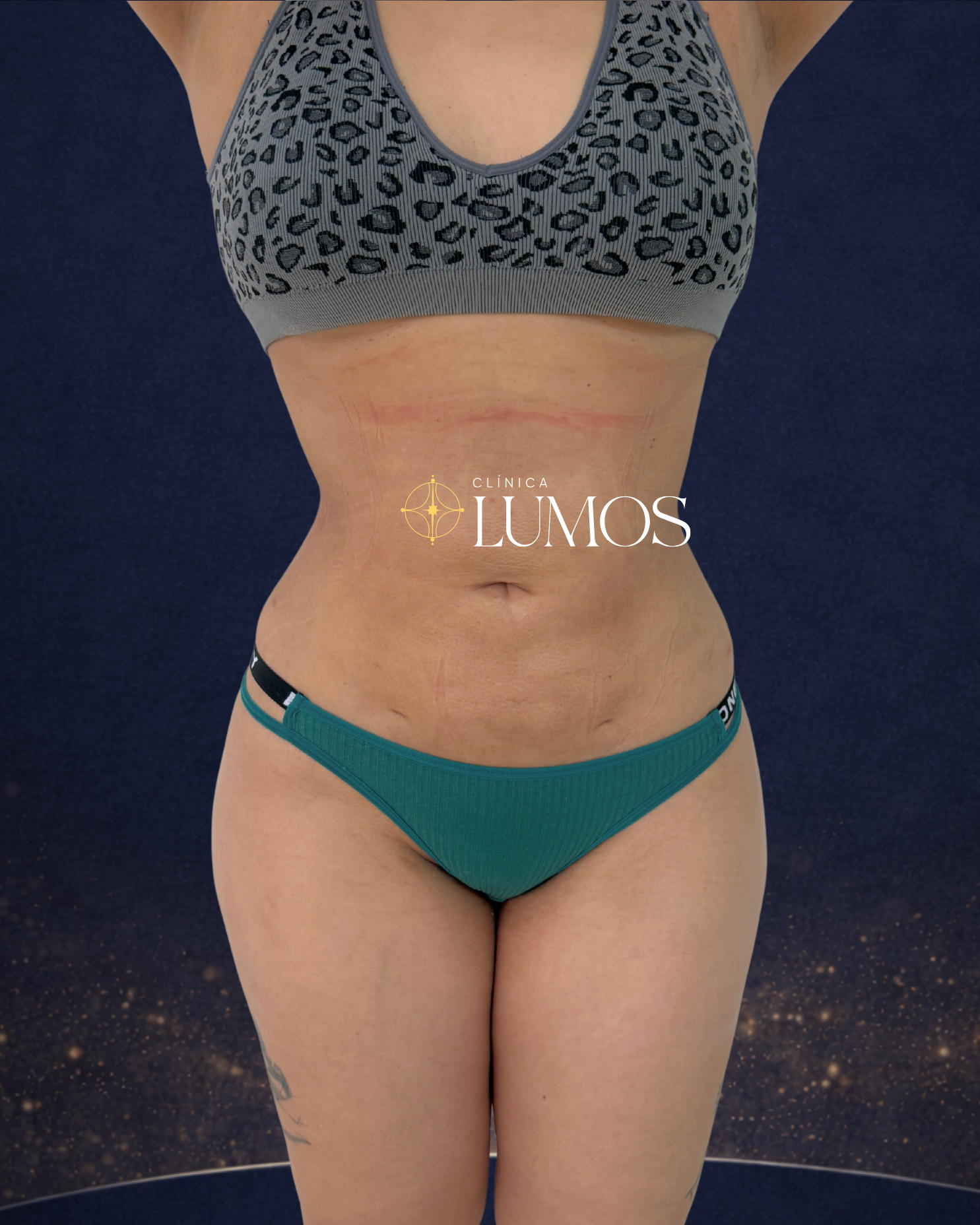 lipovaser lipolaser en viña del mar