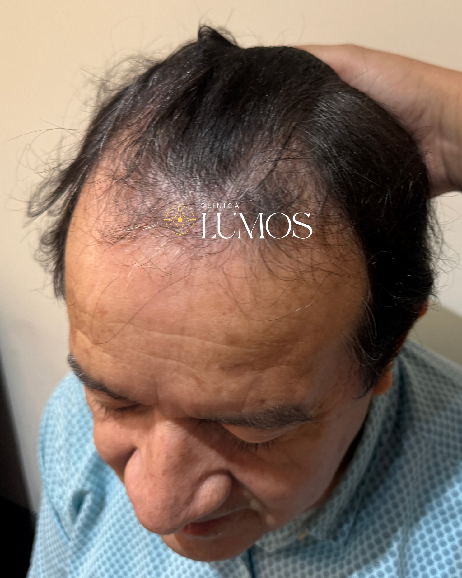 eliminar-trasplante-capilar