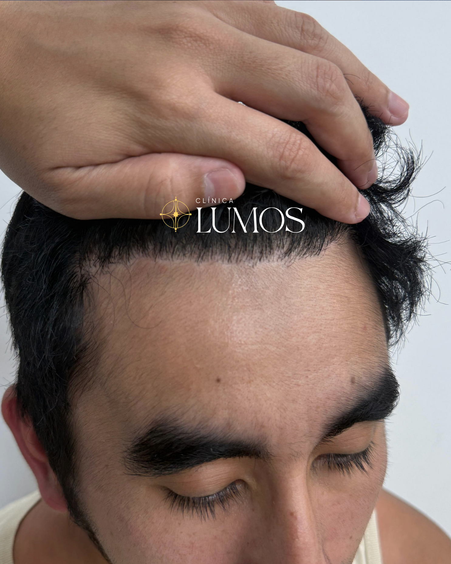 implante capilar en entradas y linea frontal con resultado definido en Viña del Mar