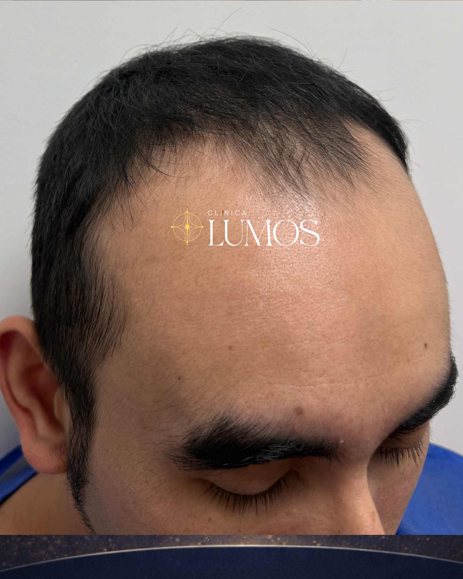 Hombre con cabello escaso en frente