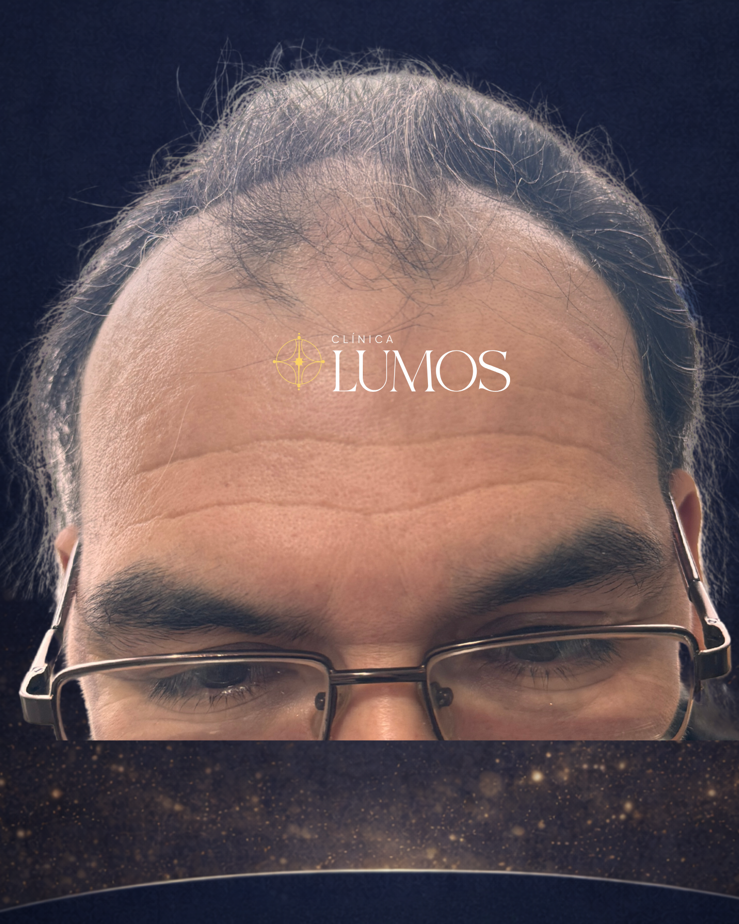 restauración capilar con alta densidad en zona frontal en Viña del Mar