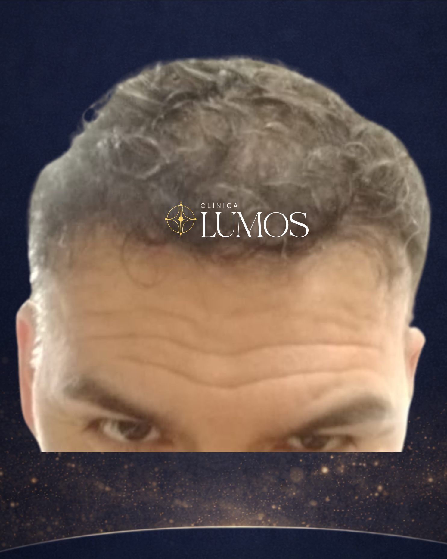 restauración capilar en zona frontal con resultado armónico en Viña del Mar