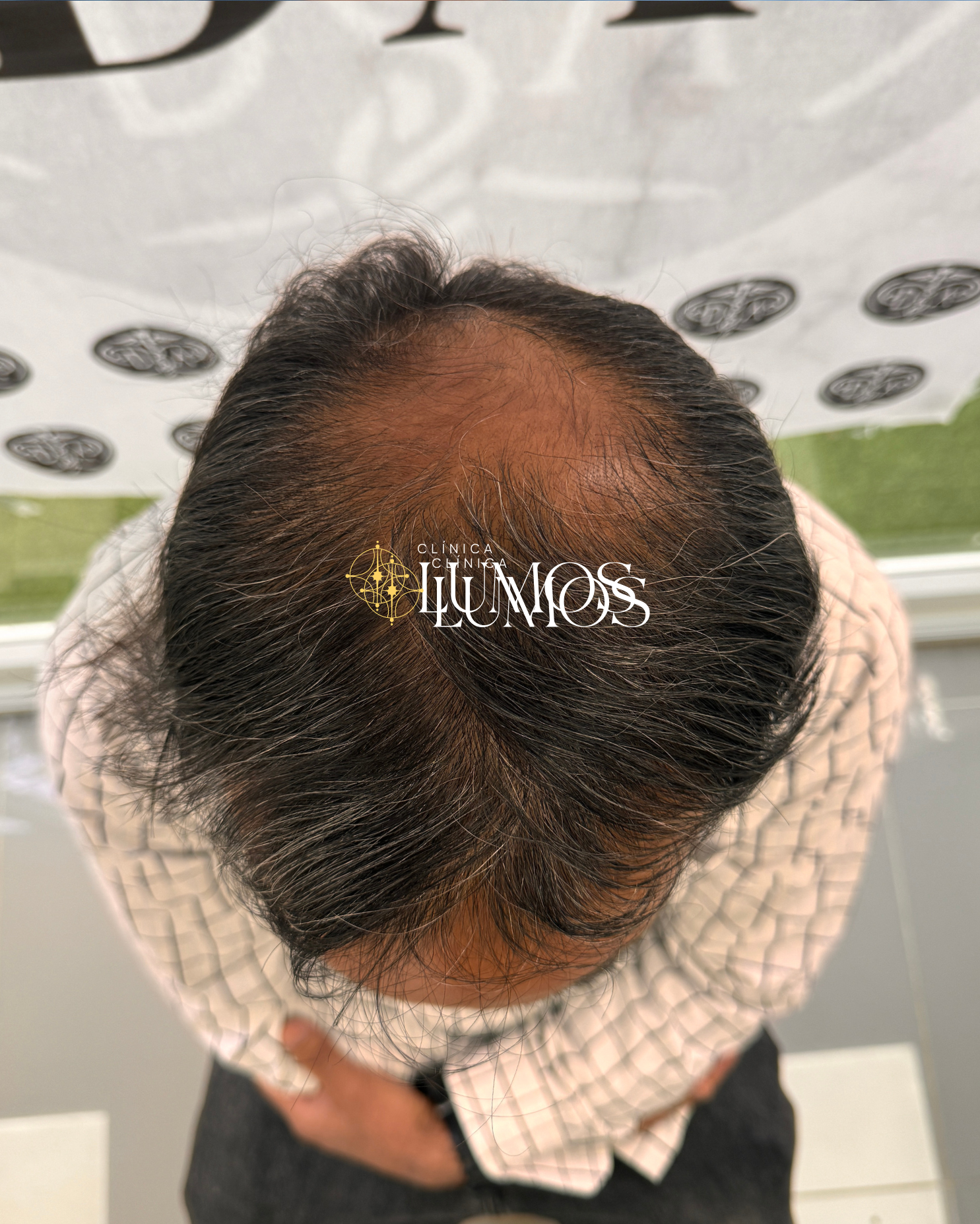 coronilla, trasplante capilar coronilla