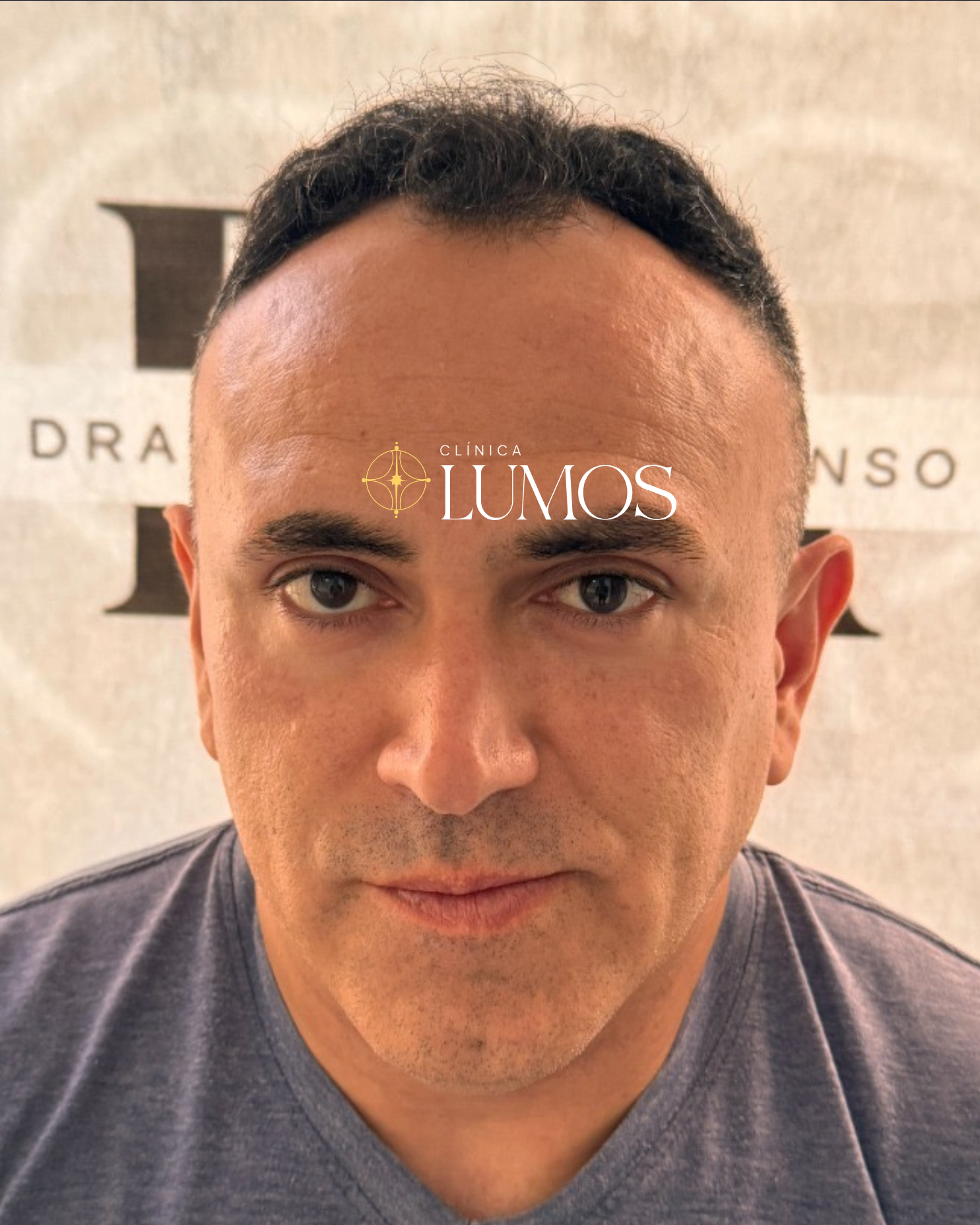 trasplante-capilar-chile-viña-del-mar