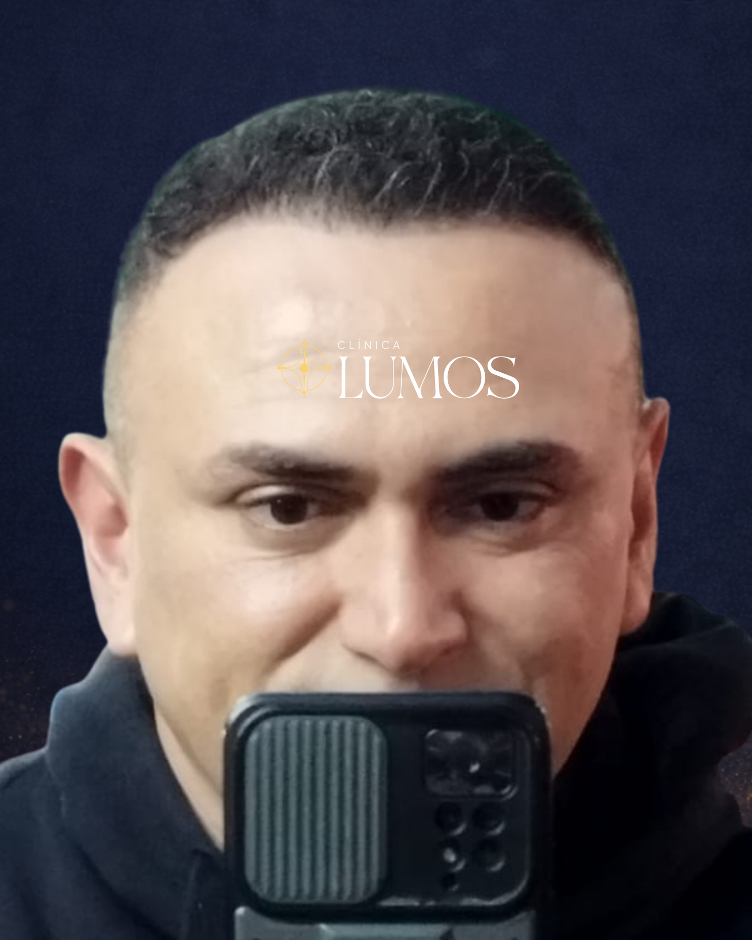 trasplante-capilar-chile-viña-del-mar