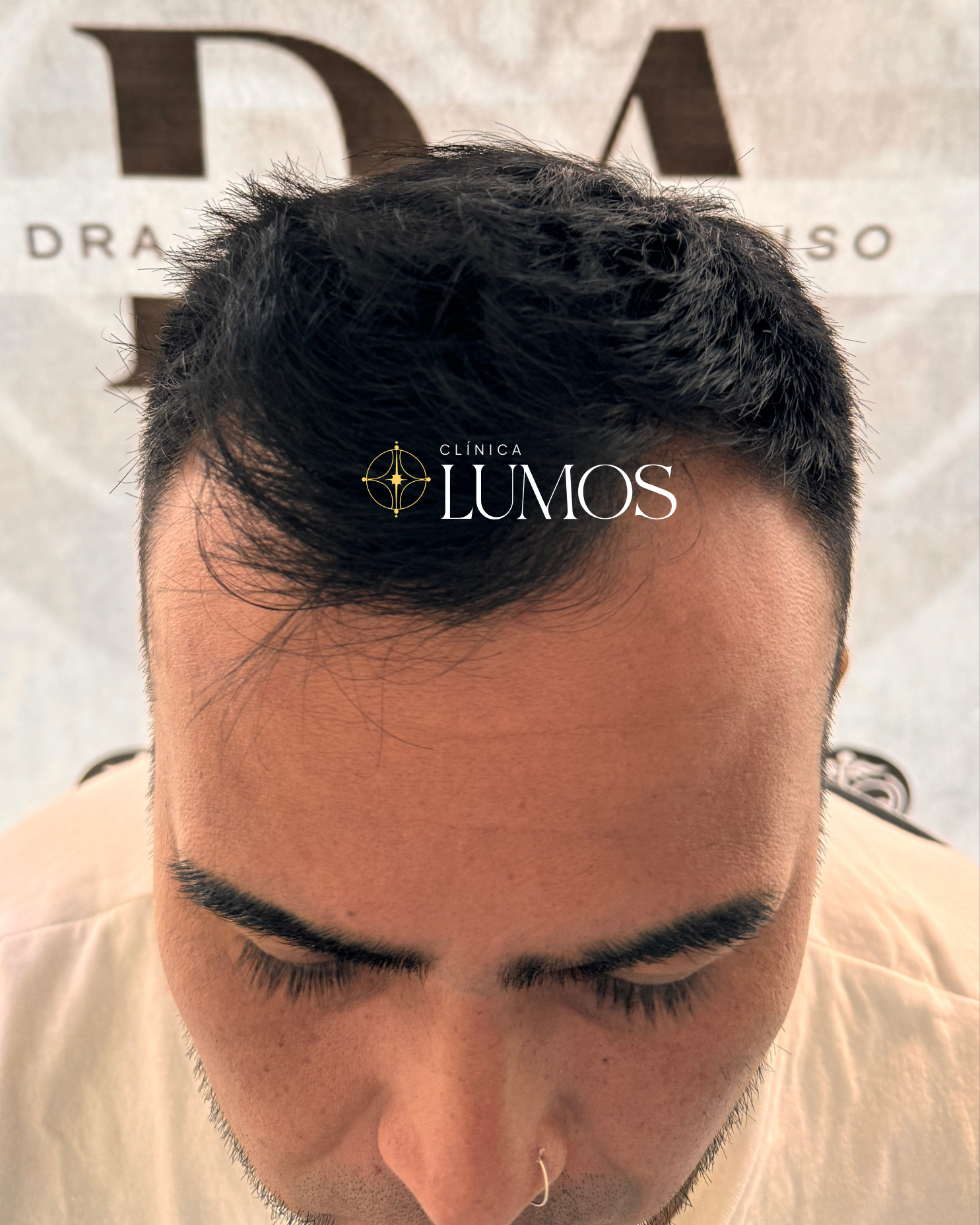 luego-trasplante-capilar