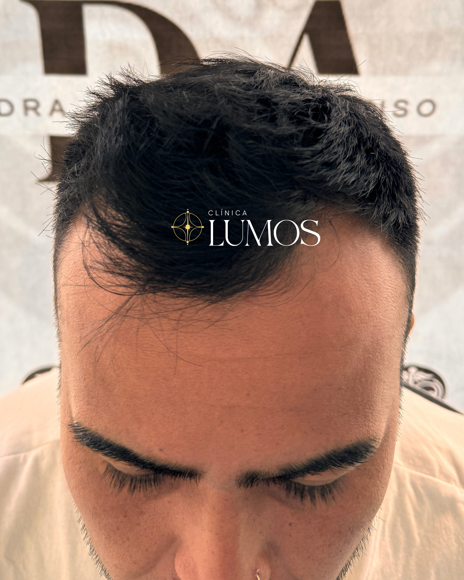 antes y despues de un trasplante capilar