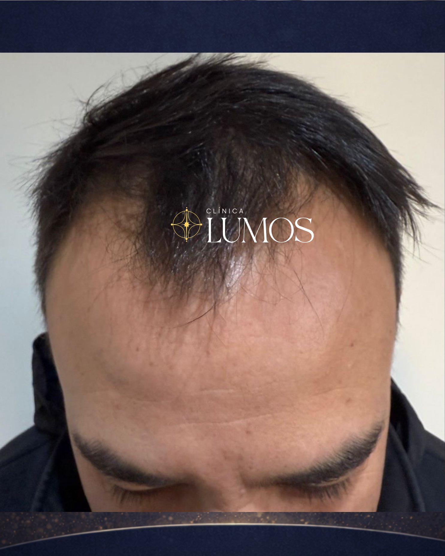 trasplante-capilar-chile