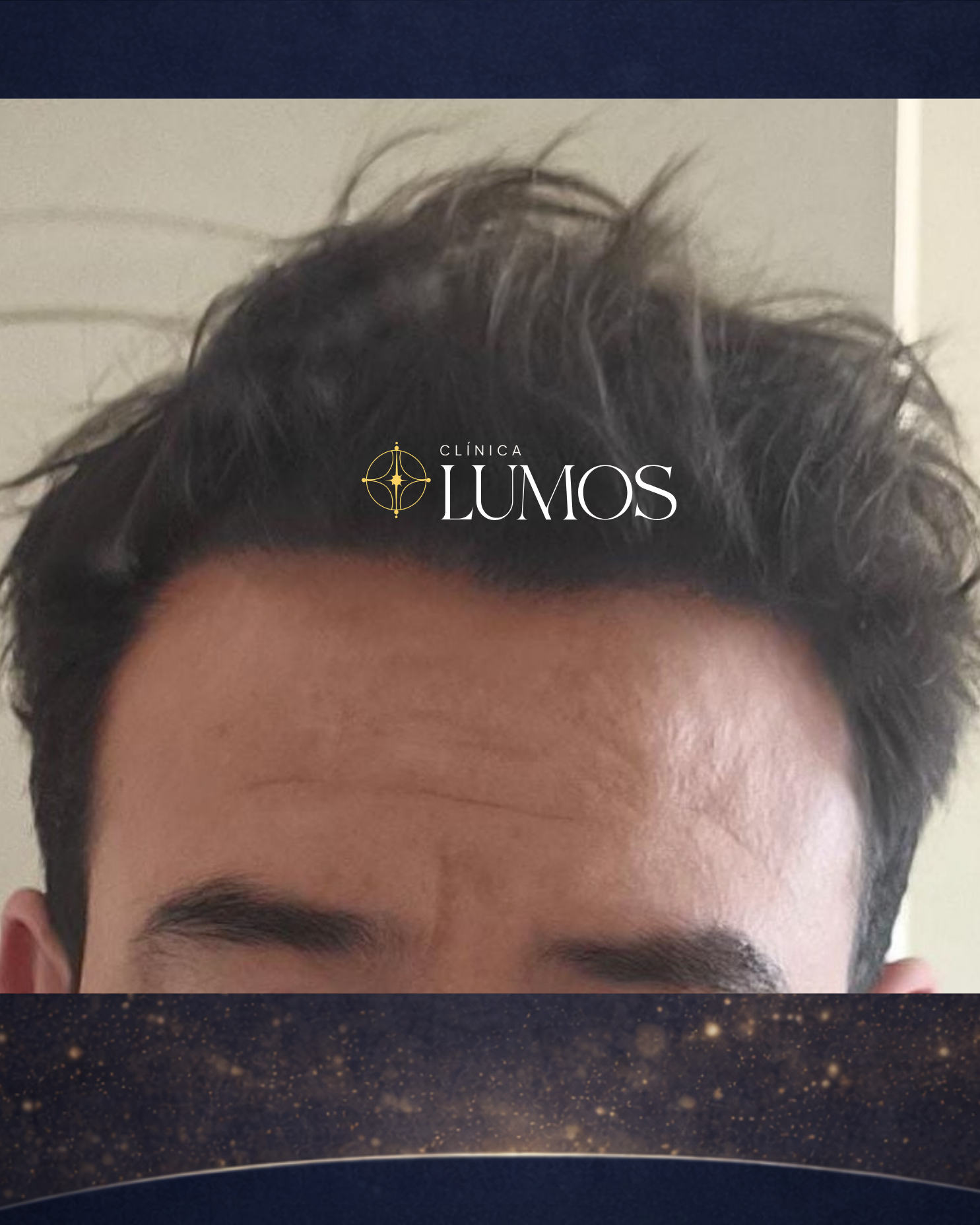 trasplante-capilar-chile-viña-del-mar