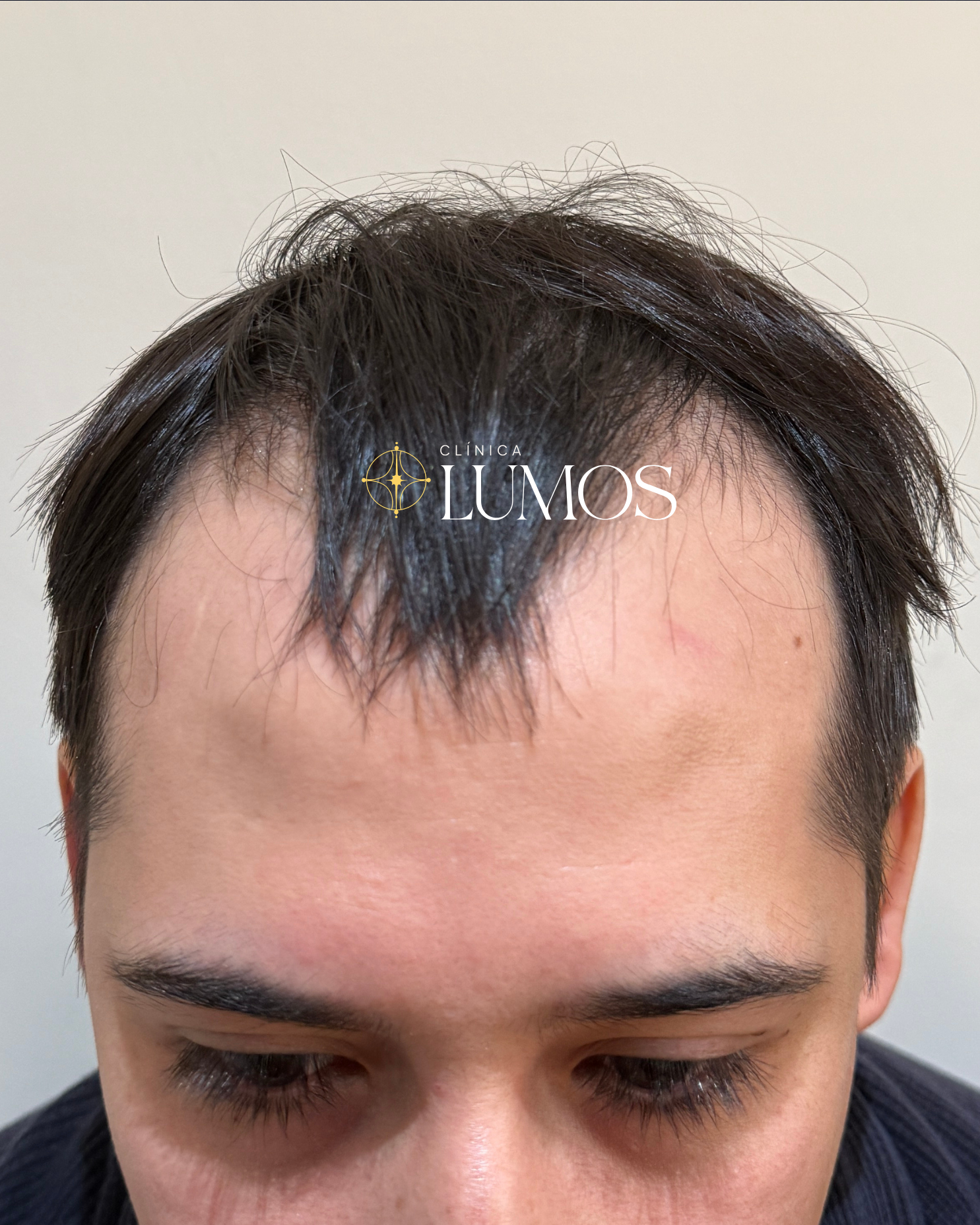 eliminar-entradas-implante-capilar