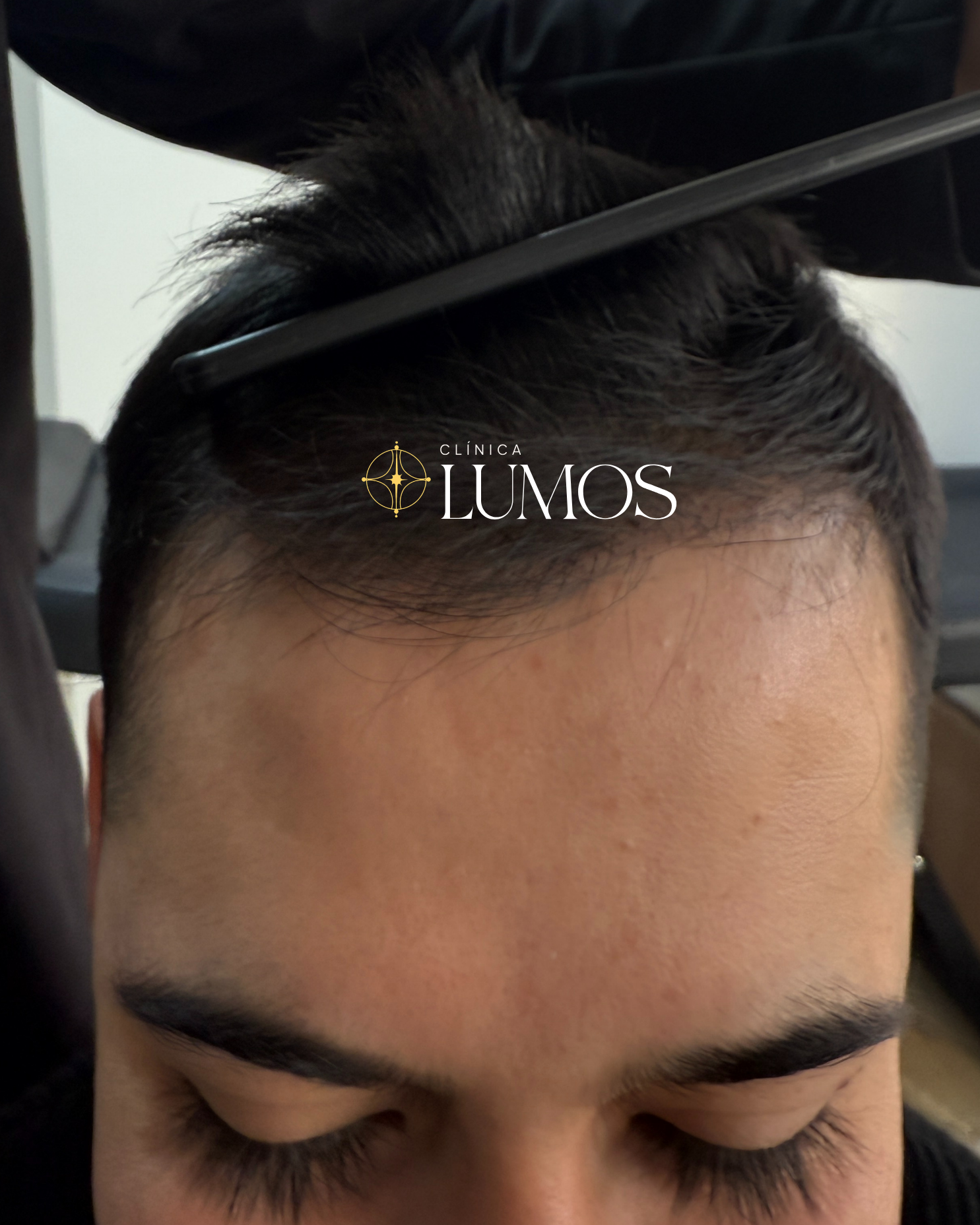 eliminar-entradas-implante-capilar