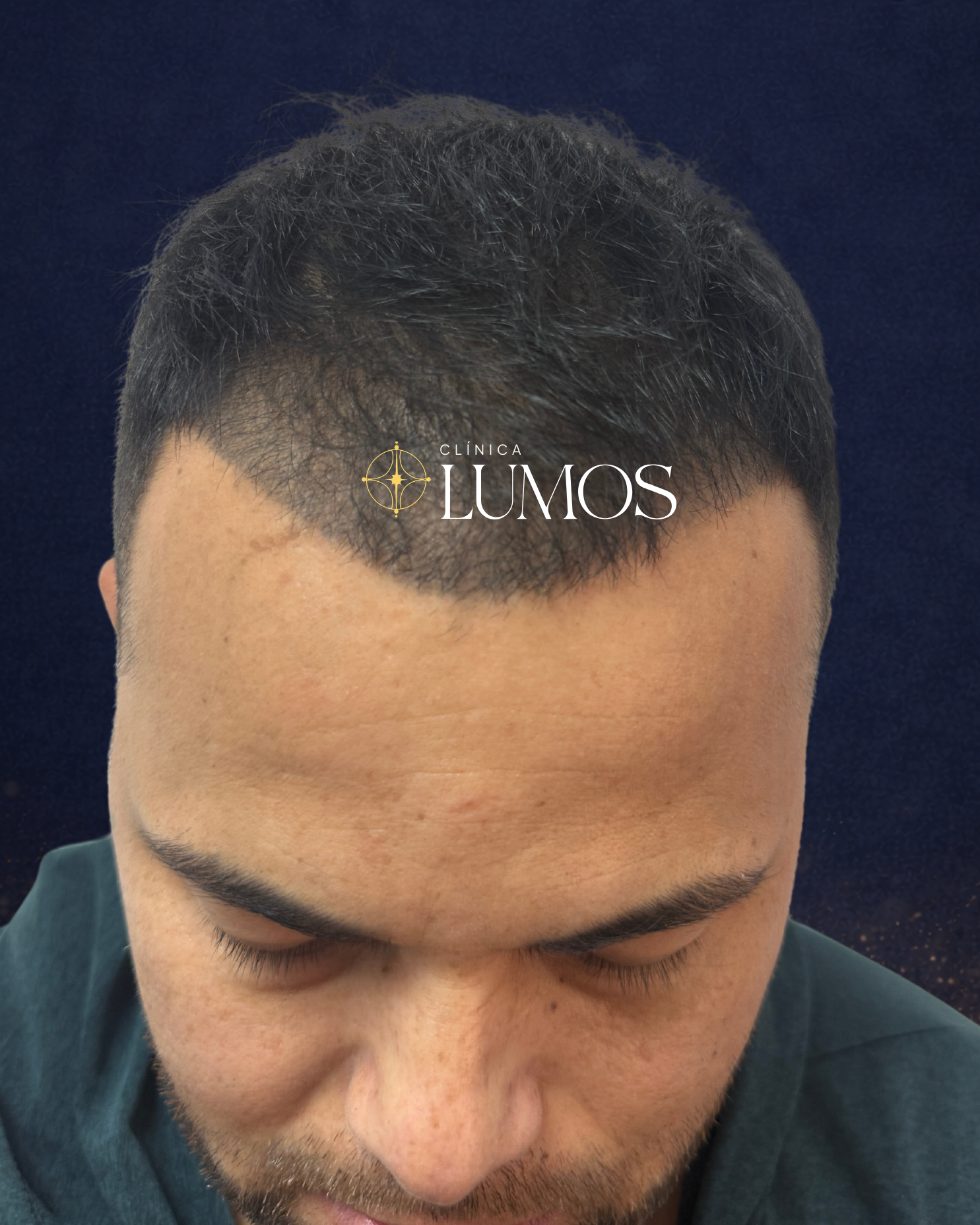 paciente-con-micropigmentación-antes -de-su-trasplante-capilar-no-le-quedó-bien-la-micropigmentación