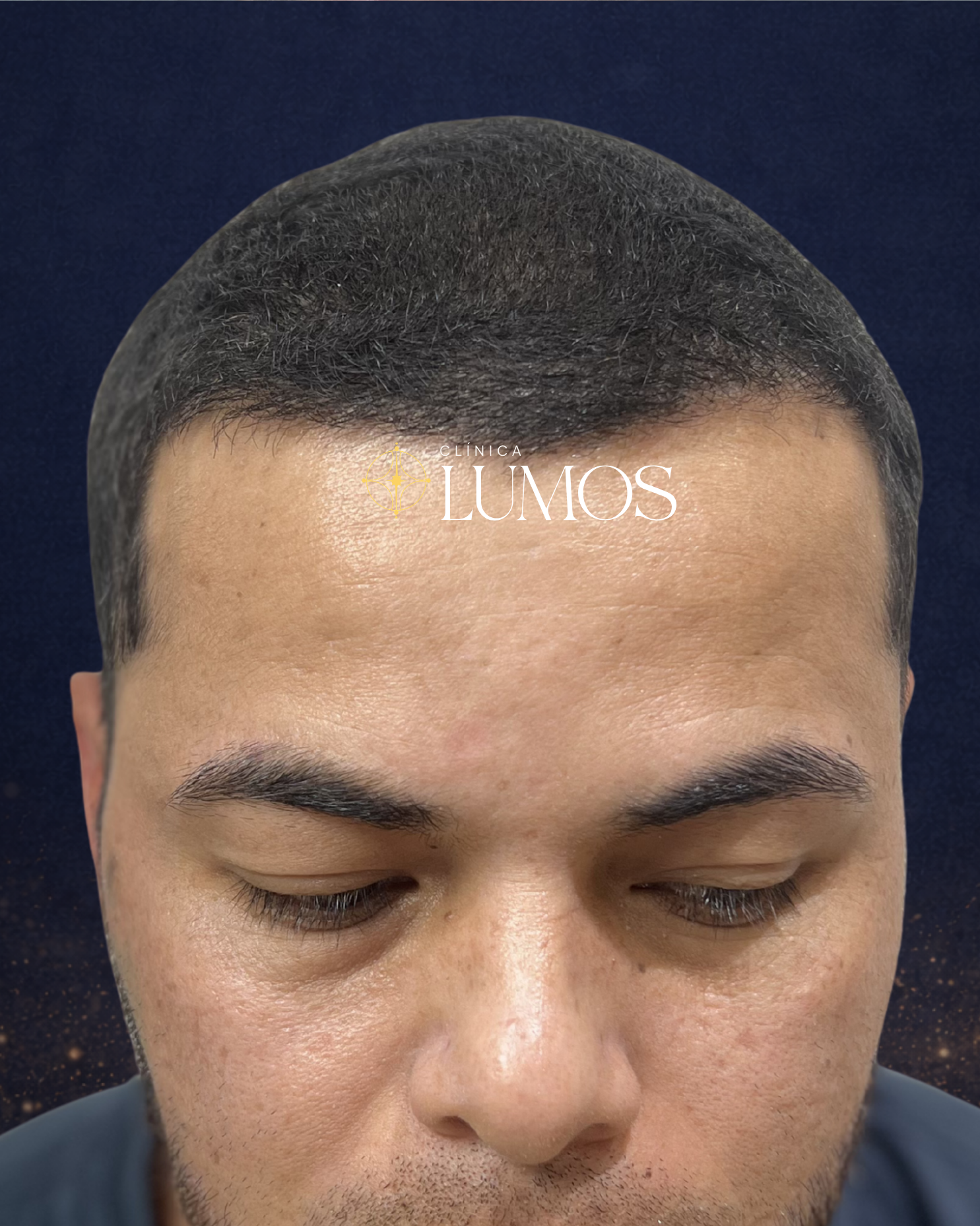 alta-densidad-implante-capilar