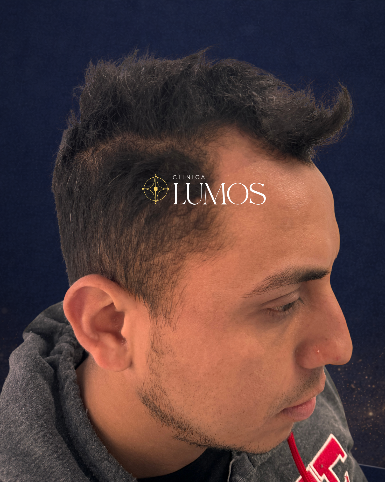 implante-capilar-chile