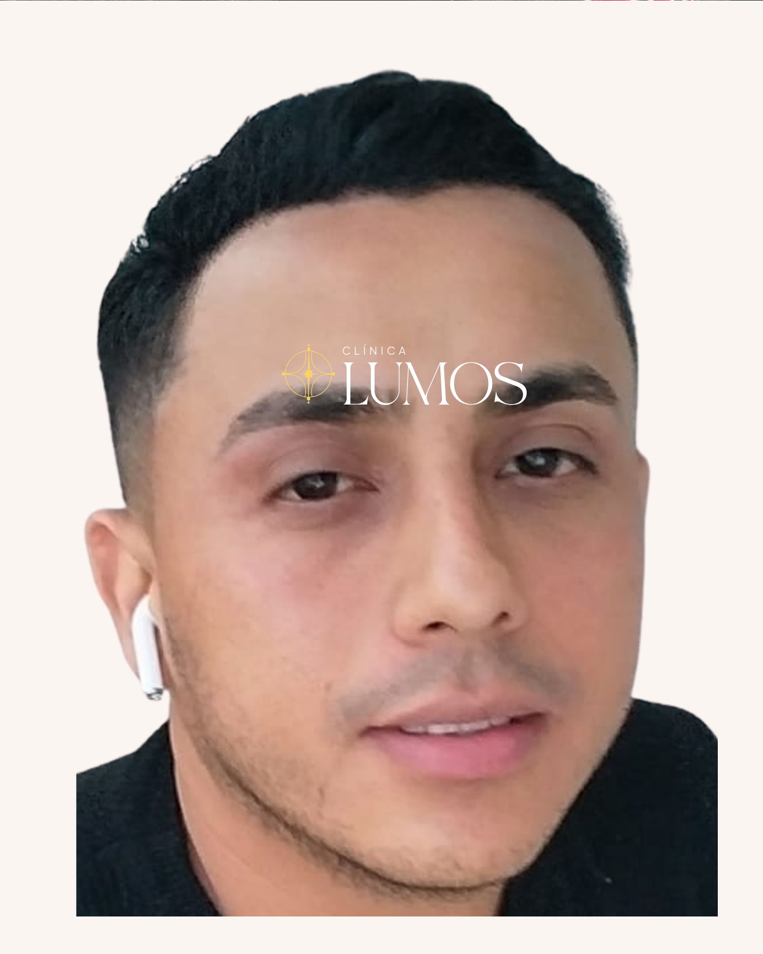 trasplante-capilar-chile