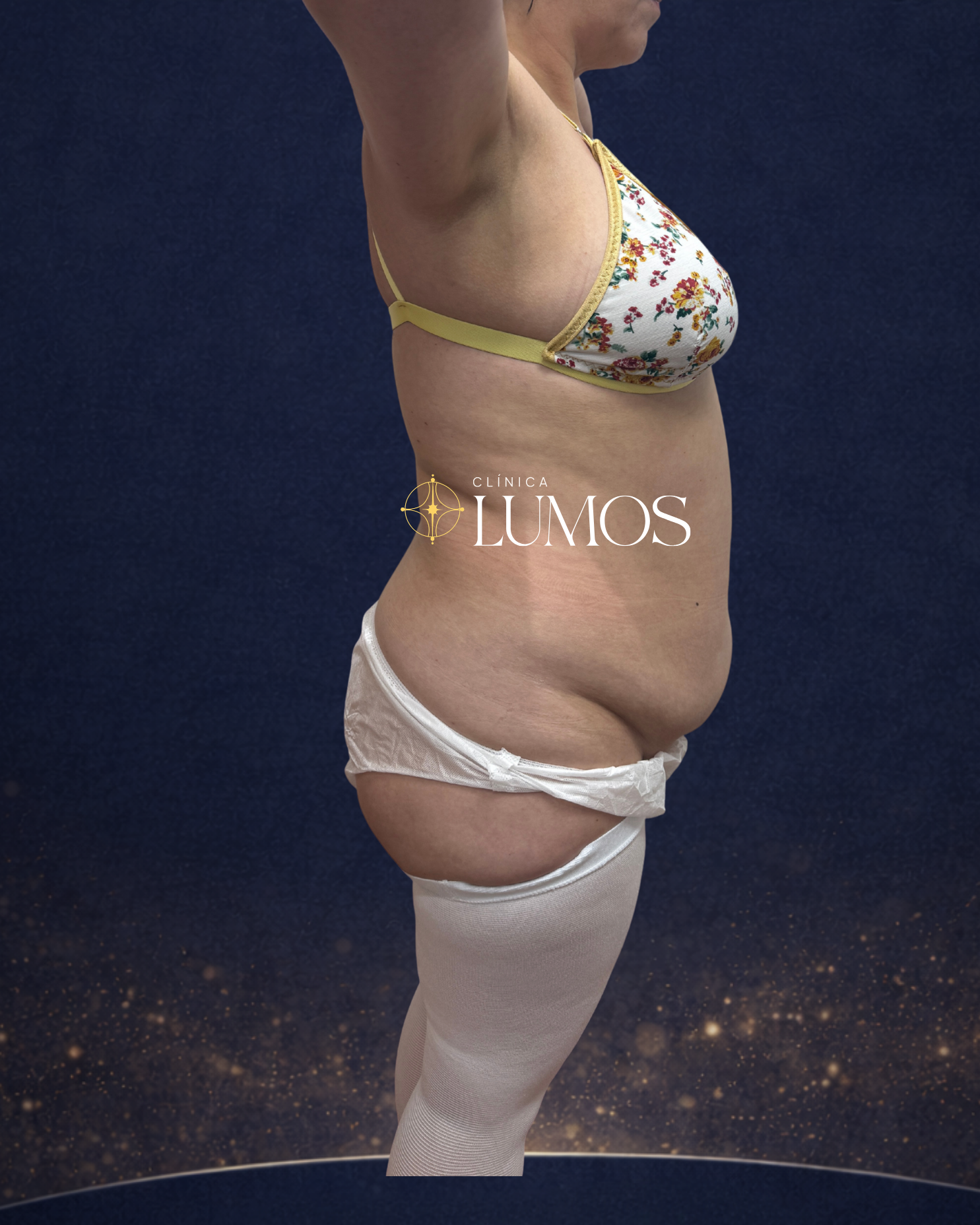 cambios de una lipolaser