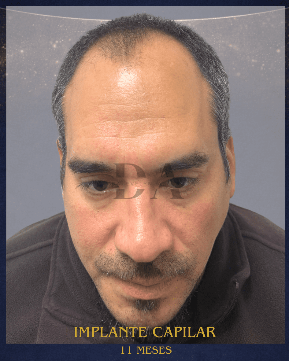 antes-de-trasplante-capilar-