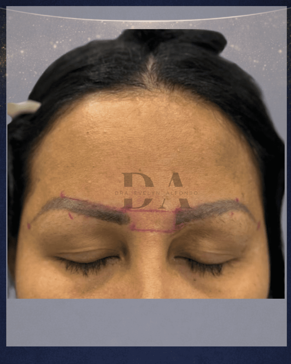 antes y después trasplante de cejas sobre tatuaje permanente dañado — Clínica Lumos Viña del Mar