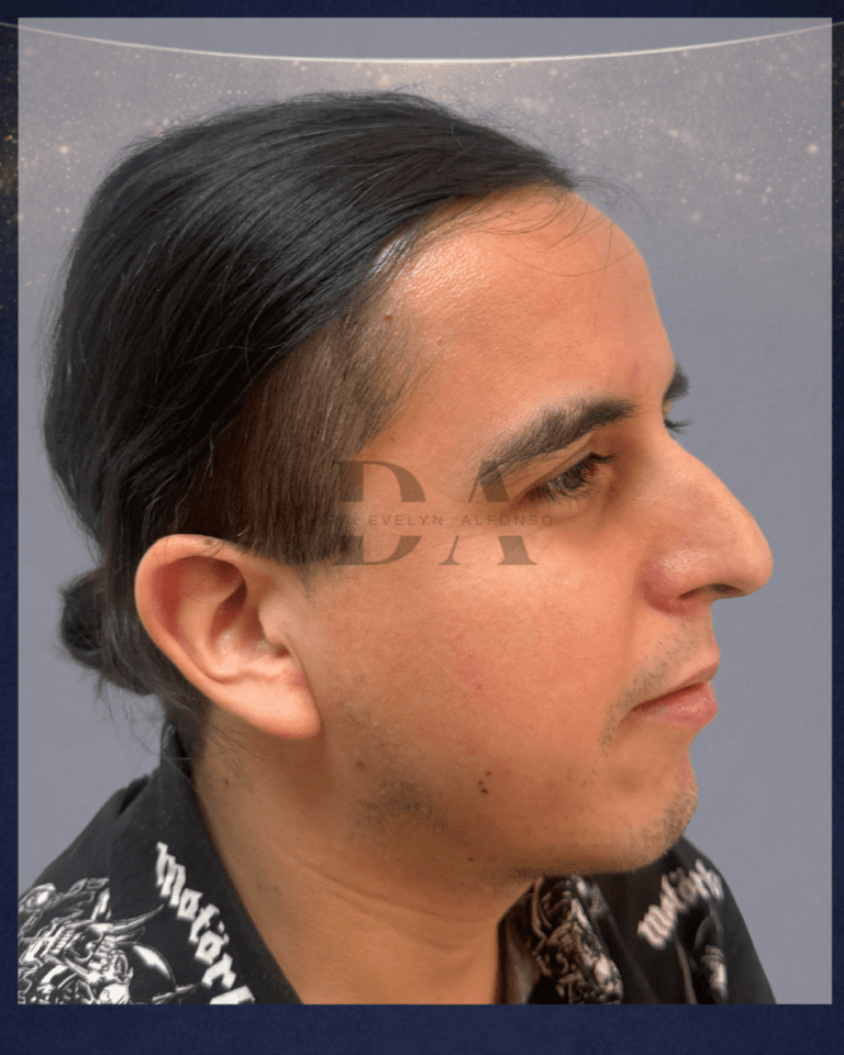 antes-trasplante-de-barba