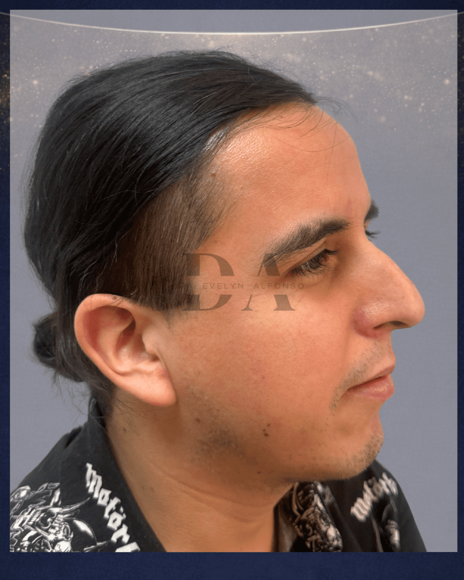 antes-trasplante-de-barba