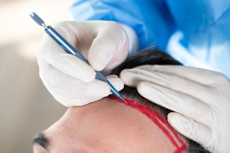 apertura de canales receptores para trasplante capilar FUE con línea frontal natural — Dra. Alfonso, Clínica Lumos Viña del Mar