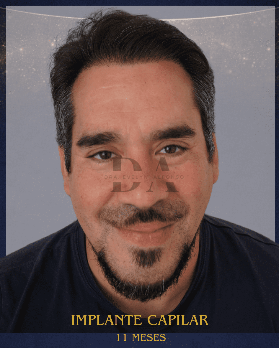despues-trasplante-capilar-alta-densidad