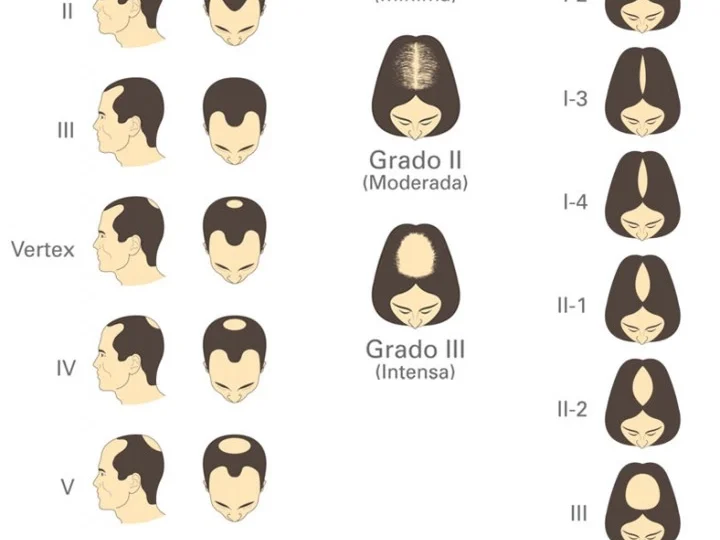 grado-alopecia-masculino-feminino.png
