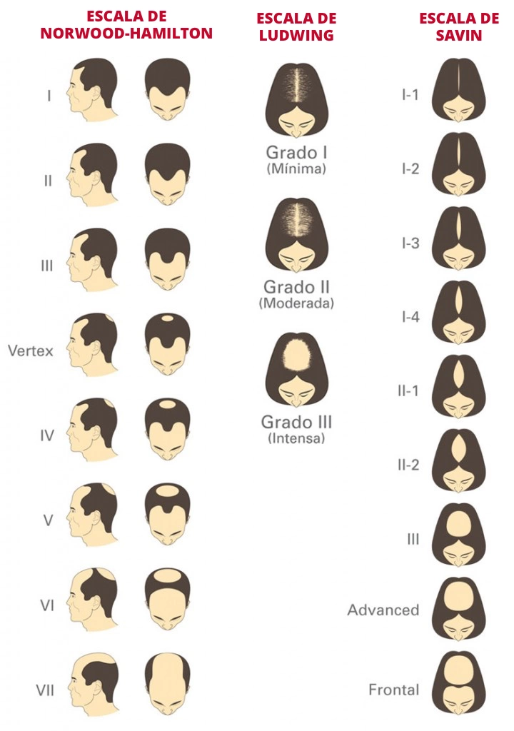 grado-alopecia-masculino-feminino.png