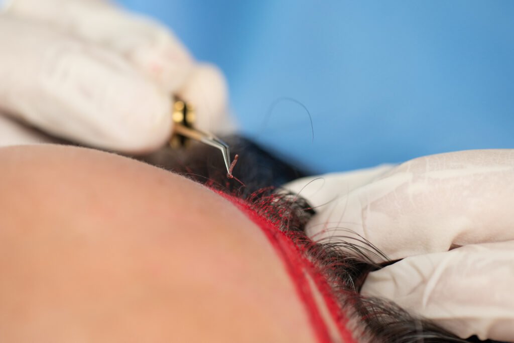 implantación de folículos con la técnica más novedosa y segura en trasplante capilar FUE — Dra. Alfonso, Clínica Lumos Viña del Mar