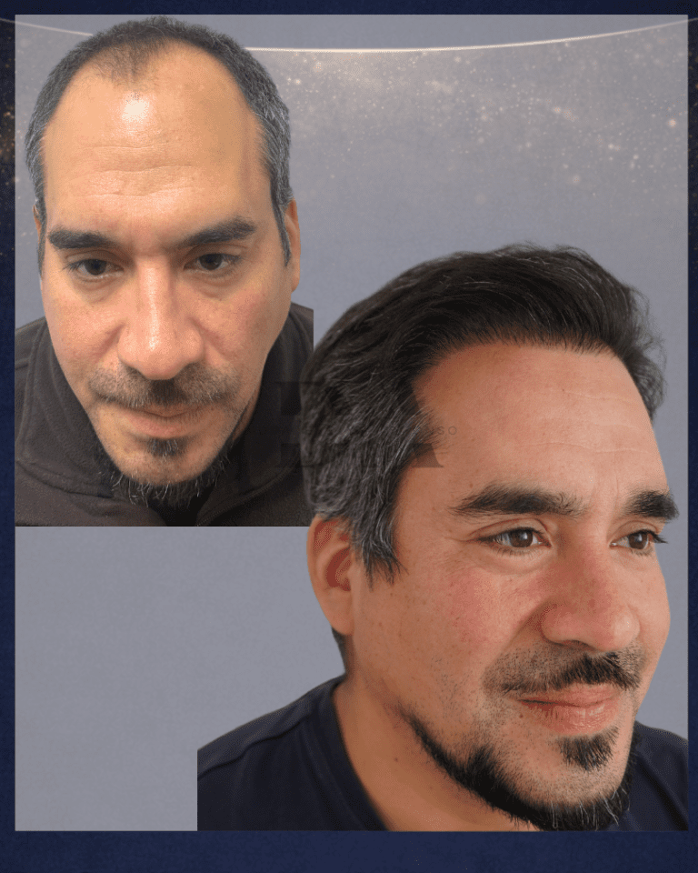 Antes y después de un implante