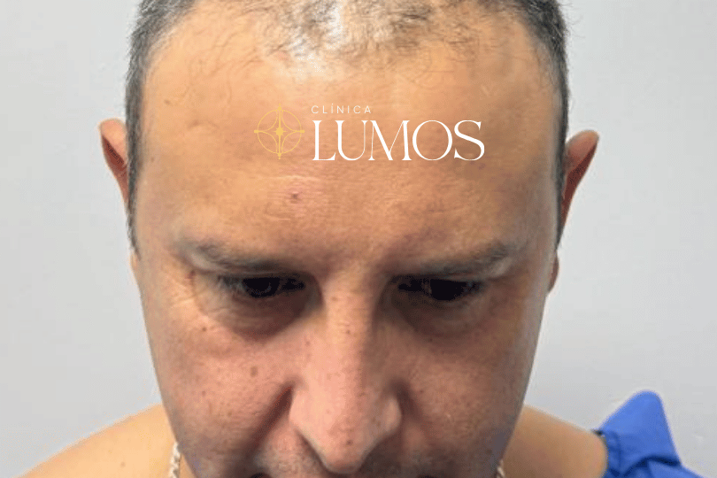 implante-capilar-masculino