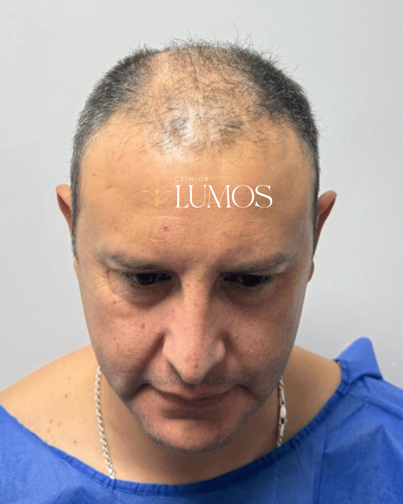 implante-capilar-masculino