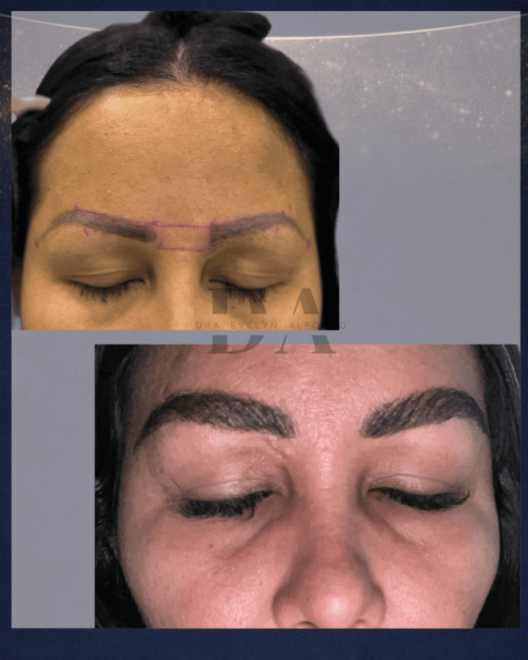implante-de-cejas-antes-y-despues-paciente