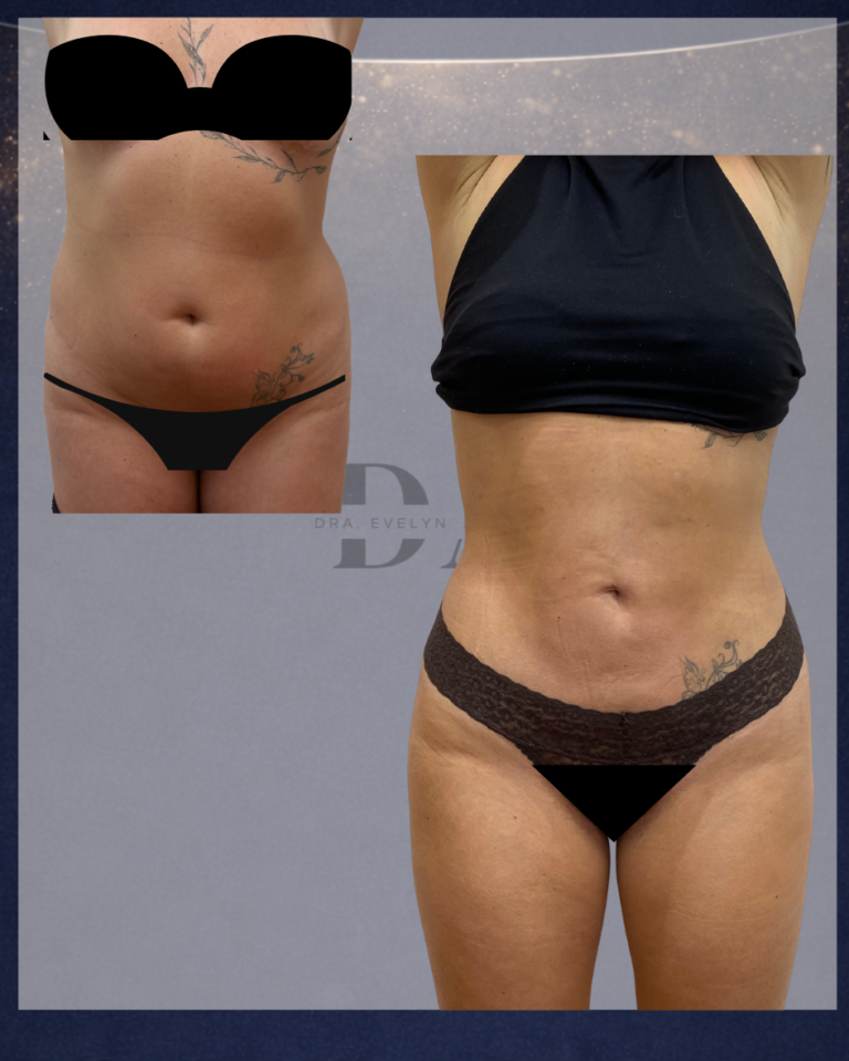 lipo-vaser-lipo-laser-eliminar-flacidez-paciente-con-dos-hijos
